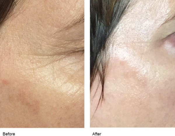Non-surgical anti-aging procedures Before and after