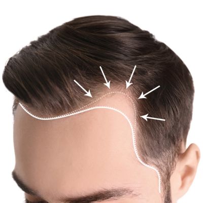Young man with hair loss problem